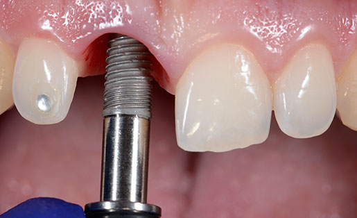 dental implants