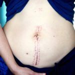 vertical surgery incision