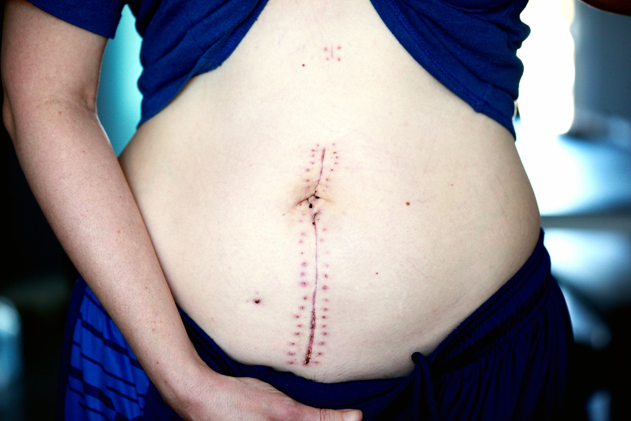 vertical surgery incision